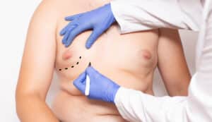 A doctor marking a man's chest for gynecomastia surgery in Quogue, NY