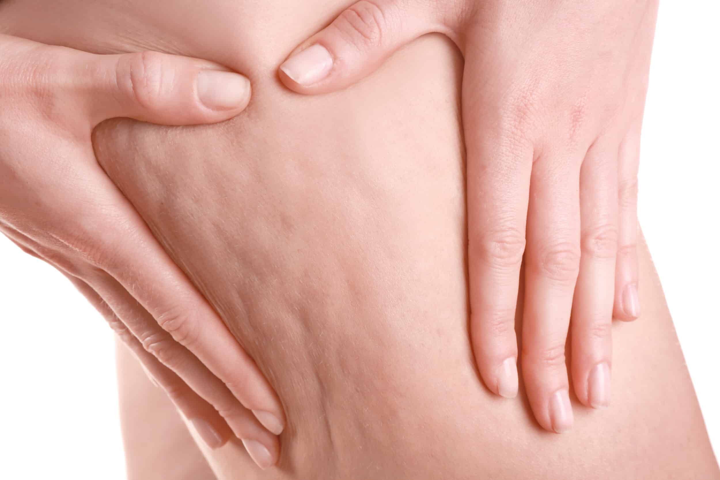 A close-up shot of cellulite on a woman's thigh